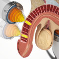 Can shockwave therapy cure erectile dysfunction?