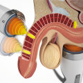 How long does it take for shock wave therapy to work for ed Mount Pleasant SC?