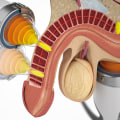 Shockwave Therapy: How Does It Work and What Are Its Benefits?