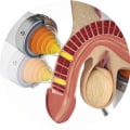 How long does wave therapy for ed last?