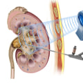 How long does shockwave therapy last for kidney stones?