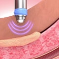 Does gainswave therapy really work?