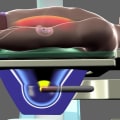 Does shockwave therapy work for kidney stones?
