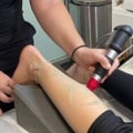 How many days between shockwave therapy?