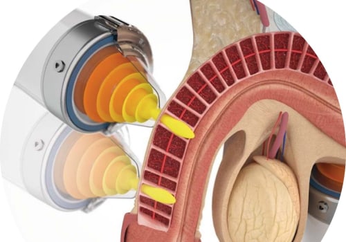 How long does wave therapy for ed last?