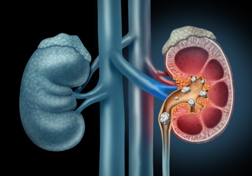 What is the fastest way to dissolve a kidney stone?