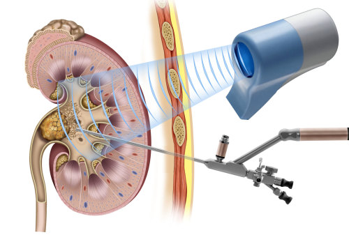 How long does shockwave therapy last for kidney stones?