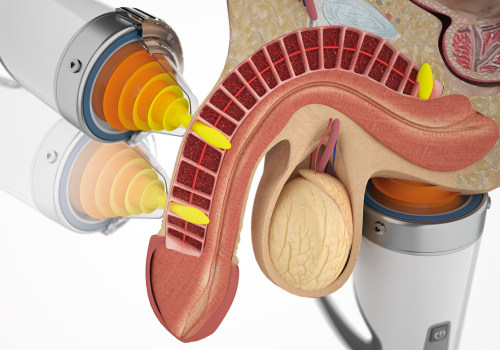 Does shockwave work for severe ed?