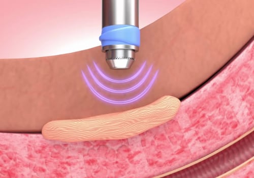 Does gainswave therapy really work?