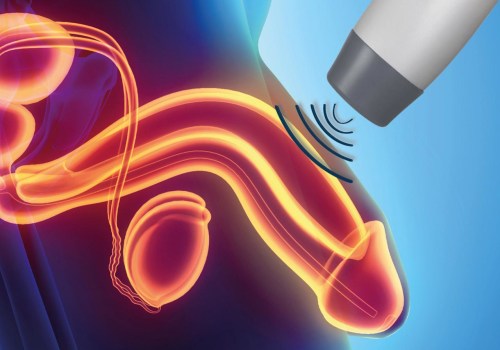 How many sessions of shockwave therapy for erectile dysfunction?