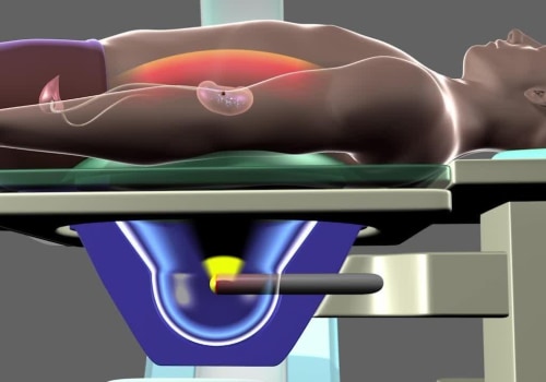 Does shockwave therapy work for kidney stones?
