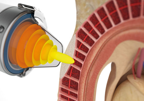 How long does shockwave therapy results last?